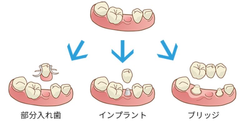 残根の治療または抜歯