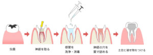 虫歯治療の流れ