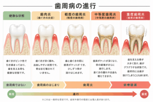 歯周病の進行段階
