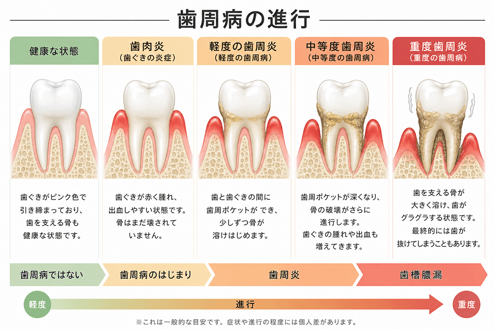 歯周病の進行段階